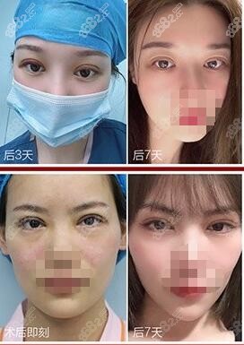 武汉艺星谭琳医生眼综合术后