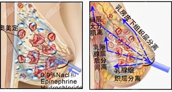 武汉做胸部奥美定取出手术