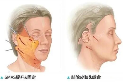 耳前切口拉皮疤痕明显吗