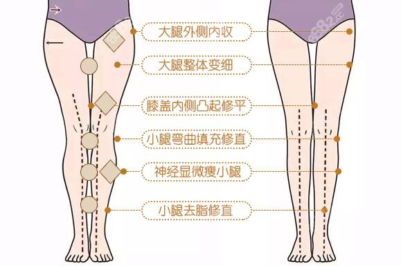 直腿术就是腿部综合矫正术
