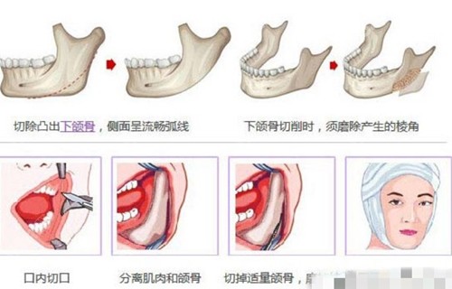 杜本军下颌角磨骨技术介绍