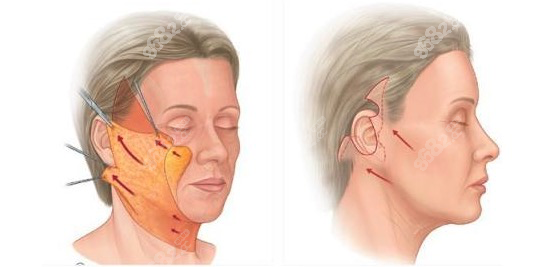 拉皮手术示意图