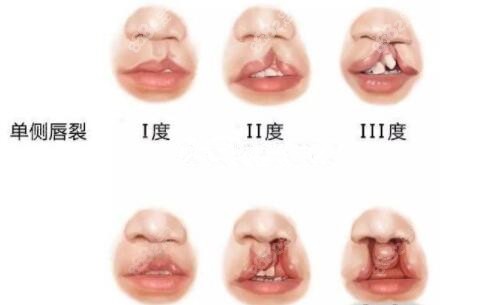 唇裂轻重程度等级 唇裂轻重程度等级