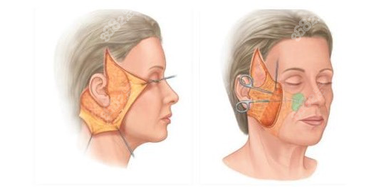 拉皮手术剥离部位