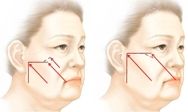 拉皮手术部位