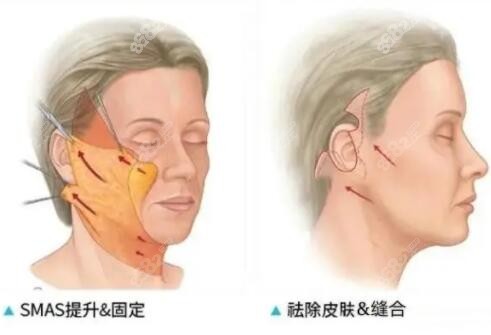 石家庄哪里做拉皮手术好