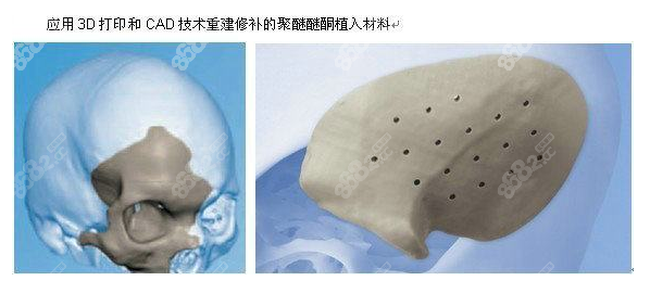 3D打印定制人工骨技术