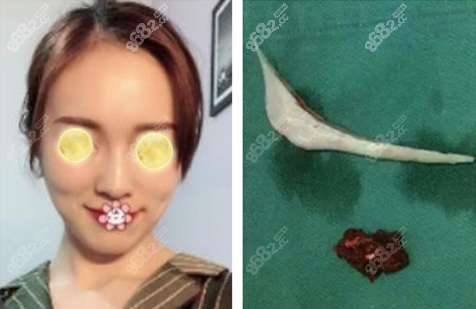 吴中兴下颌角磨骨范例术后