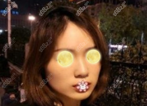 吴中兴下颌角磨骨范例术前