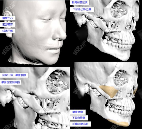 颧骨内推修复3D打印技术
