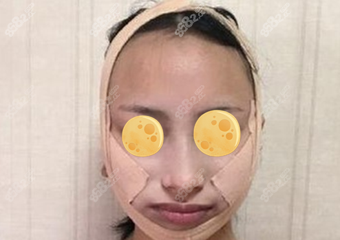 吴中兴正颌手术范例术后即刻