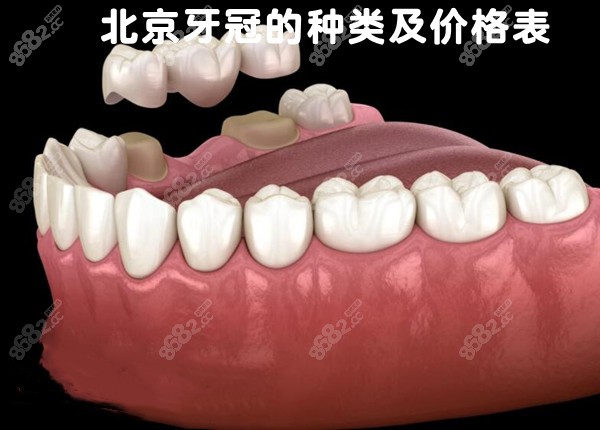 北京牙冠的种类及价格表