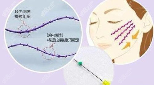 长沙做面部埋线提升的手术原理