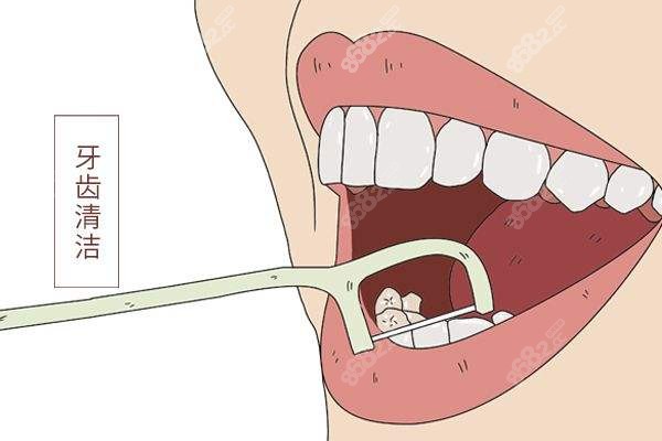 种植牙后注意口腔卫生可避免炎症