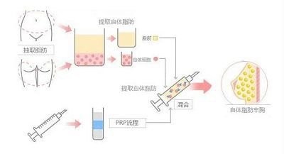 自体胶原蛋白丰胸手术过程