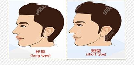 鬓角植发前后对比图