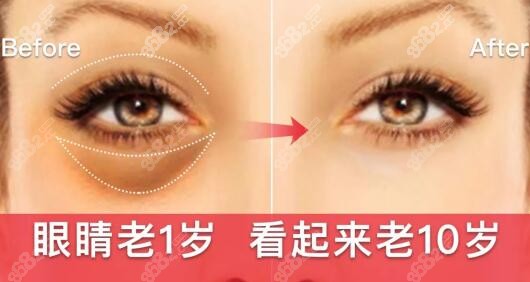 武汉割眼袋做得好的医生