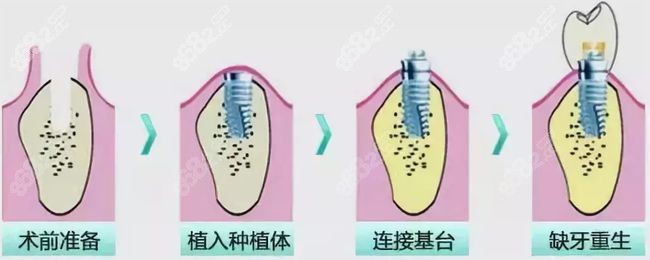 种植牙后产生牙龈炎症要找正规的医院医治