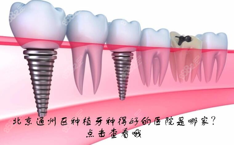 北京通州区种植牙种得好又便宜的牙科