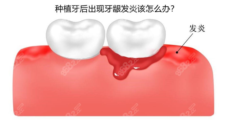 种植牙后出现牙龈发炎该怎么处理