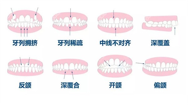 常州地包天牙齿矫正难度