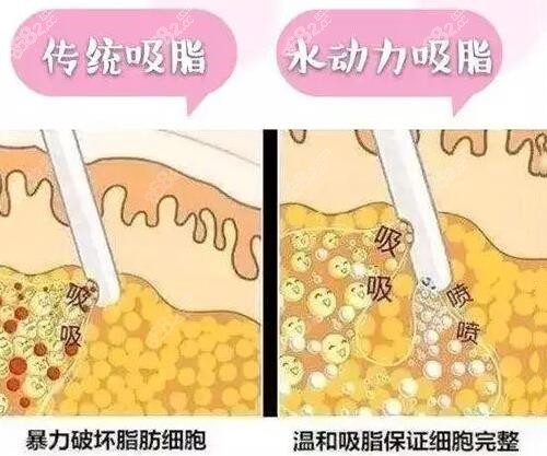 水动力吸脂的优势