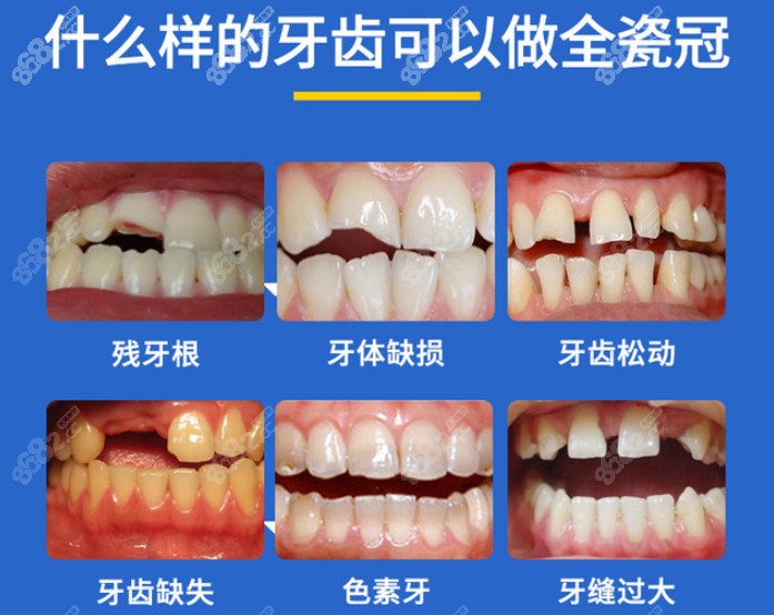 来看看做全瓷牙冠的适应症有哪些