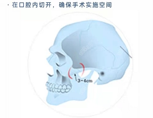 韩国颧骨缩小哪家医院好