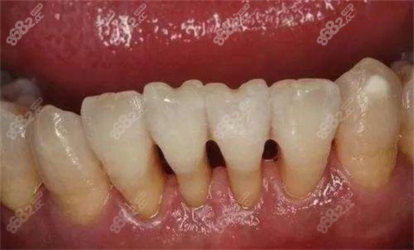 牙齿黑三角怎么补救牙齿黑三角修复需要多少钱