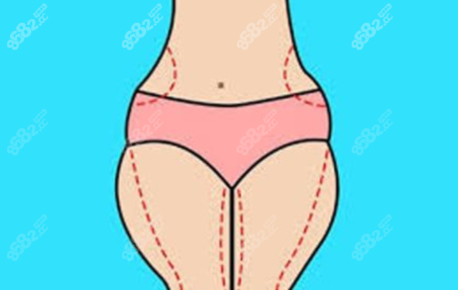 吸脂瘦腿