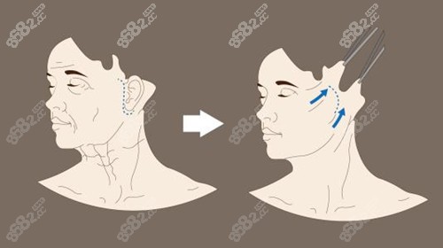 西安拉皮手术哪位医生做的好？