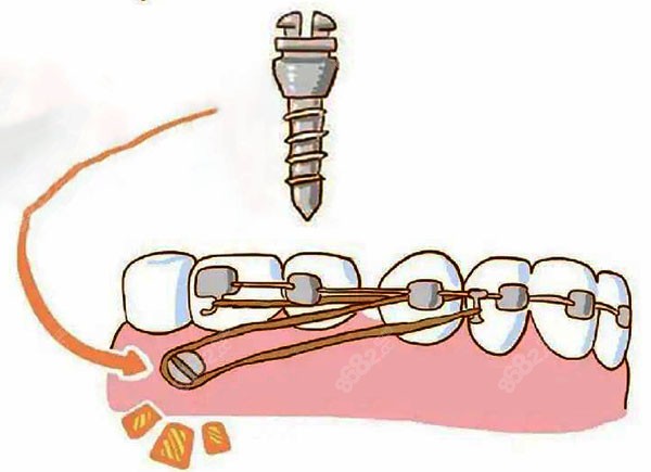 龅牙/深覆颌为什么要打骨钉