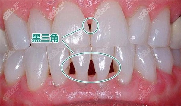 牙齿黑三角怎么补救牙齿黑三角修复需要多少钱