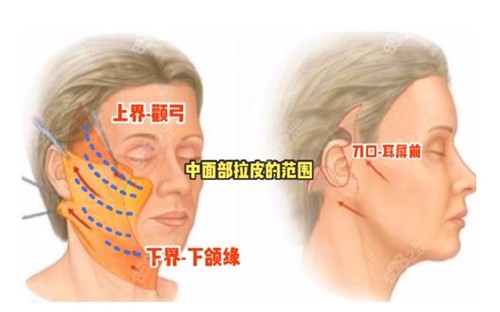 张林宏医生拉皮手术原理