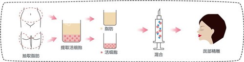 脂肪填充过程