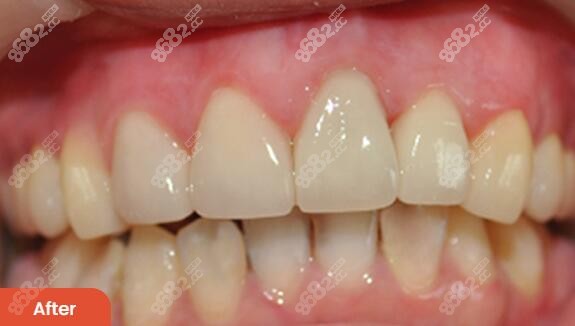 <!--<i data=20240705-sp></i>-->植牙口腔全口植牙术后