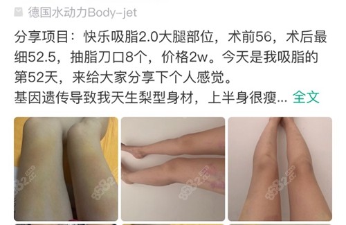 求美者在苏州美贝尔整形美容医院做大腿吸脂反馈