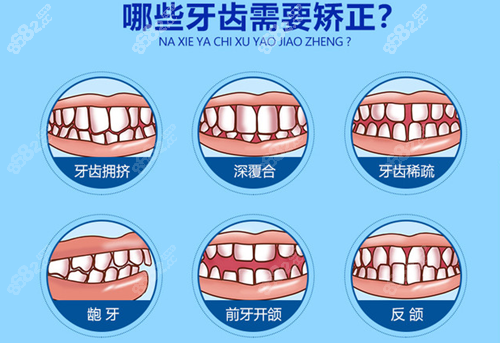 需要做牙齿矫正的情况