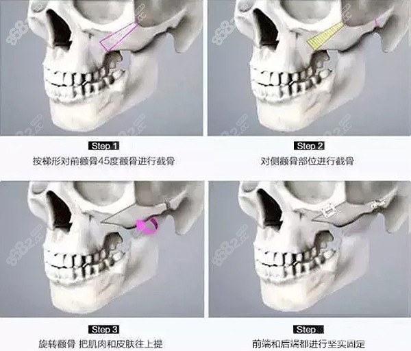 3d回旋颧骨手术的原理图解