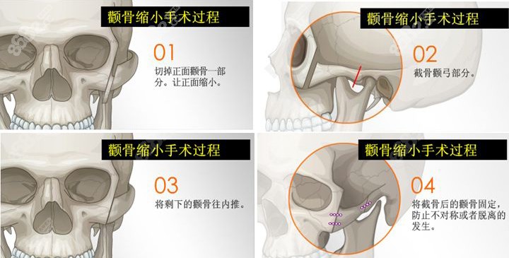 普通颧骨截骨术的原理图解