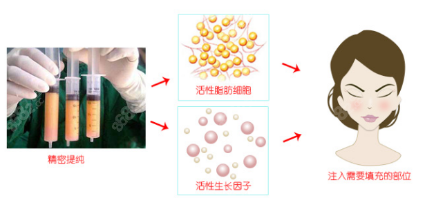 北京脂肪填充好的医生