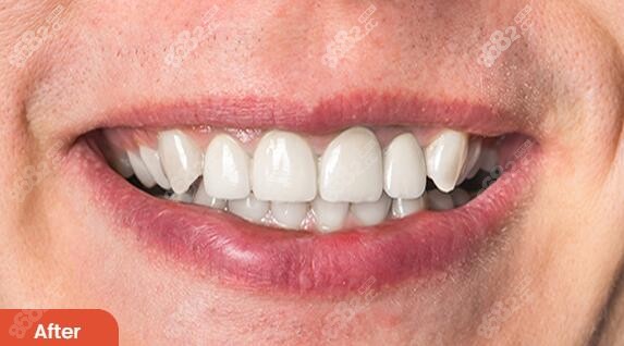 <!--<i data=20240705-sp></i>-->单颗种植牙术后