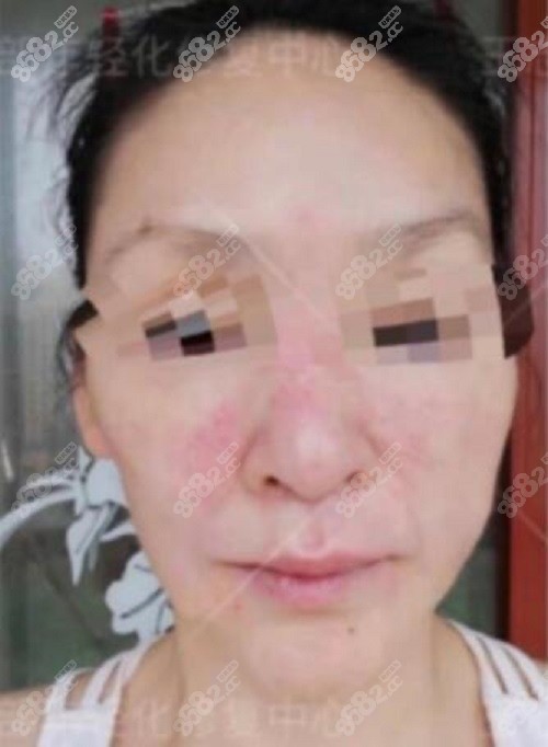 西安国际医学中心取奥美定真好王志军团队奥美定取出分享