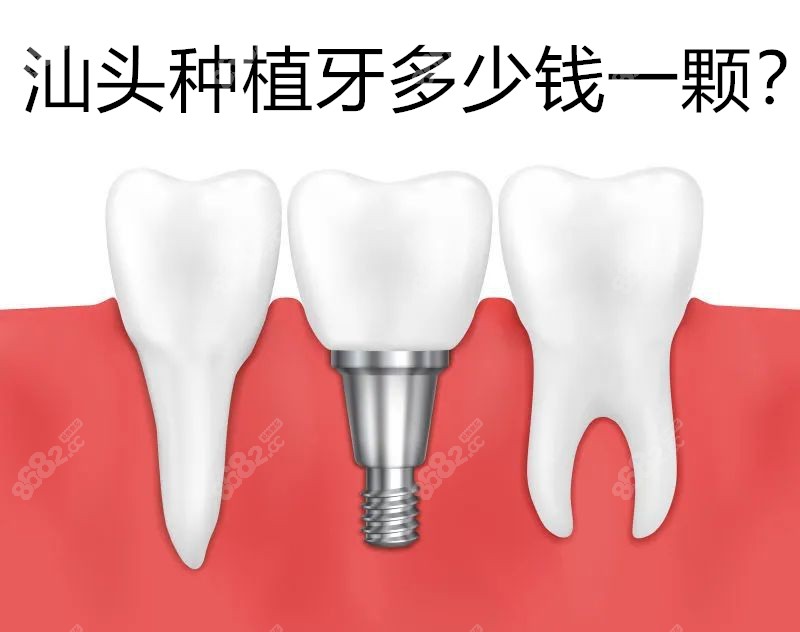 汕頭種植牙多少錢一顆 汕頭種植牙多少錢一顆