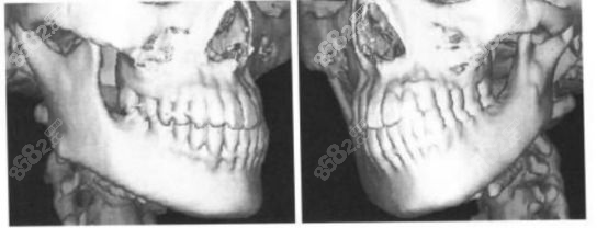 小下颌示意图