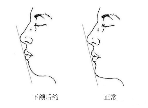 小下颌一定要手术吗图片