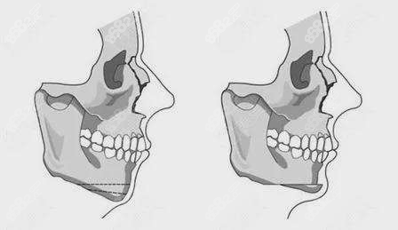 小下颌示意图