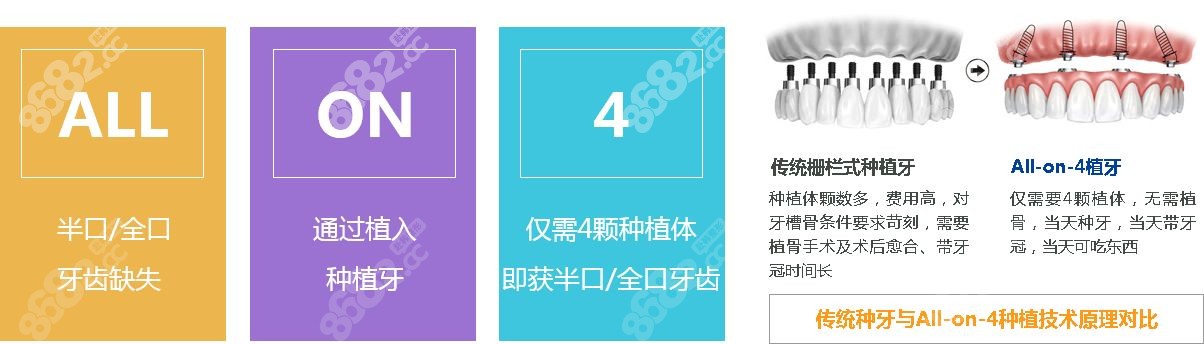 all-on-4種植牙技術(shù) all-on-4種植牙技術(shù)