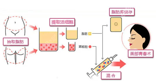 广州自体脂肪填充好的医生医院名单