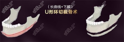 院长下颌角磨骨